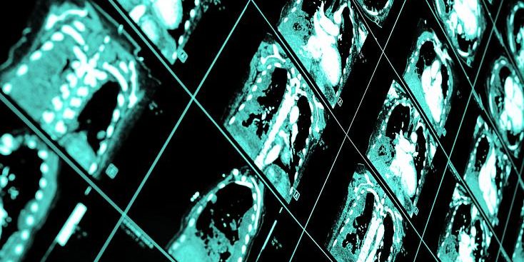 Мариинская больница создает нейросеть для анализа медицинских снимков